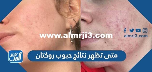 متى تظهر نتائج حبوب روكتان 2025 3 متى تظهر نتائج حبوب روكتان