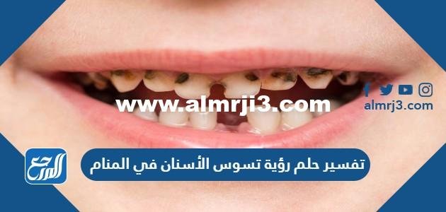 تفسير حلم رؤية تسوس الأسنان في المنام للعزباء والمتزوجة والحامل 2025 3 تفسير حلم رؤية تسوس الأسنان في المنام للعزباء والمتزوجة والحامل