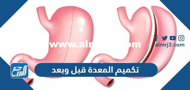 تكميم المعدة قبل وبعد بالصور 2025 2 تكميم المعدة قبل وبعد بالصور