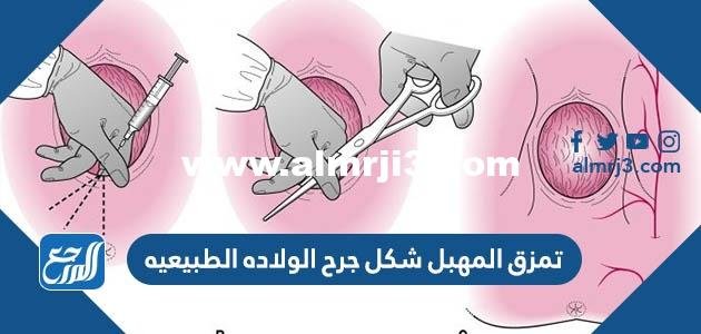 تمزق المهبل شكل جرح الولاده الطبيعيه