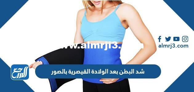 شد البطن بعد الولادة القيصرية بالصور