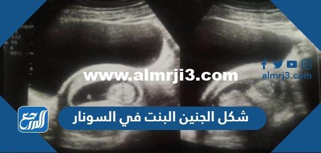 شكل الجنين البنت في السونار بالصور