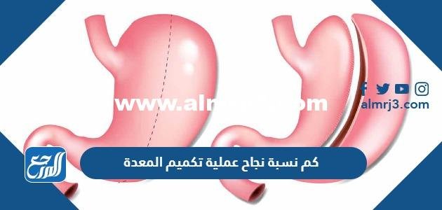 كم نسبة نجاح عملية تكميم المعدة وهل تشكل خطر