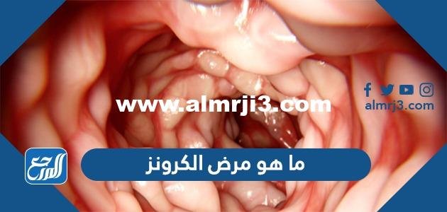ما هو مرض الكرونز وهل هو خطير