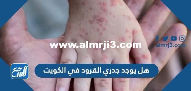 هل يوجد جدري القرود في الكويت 2025